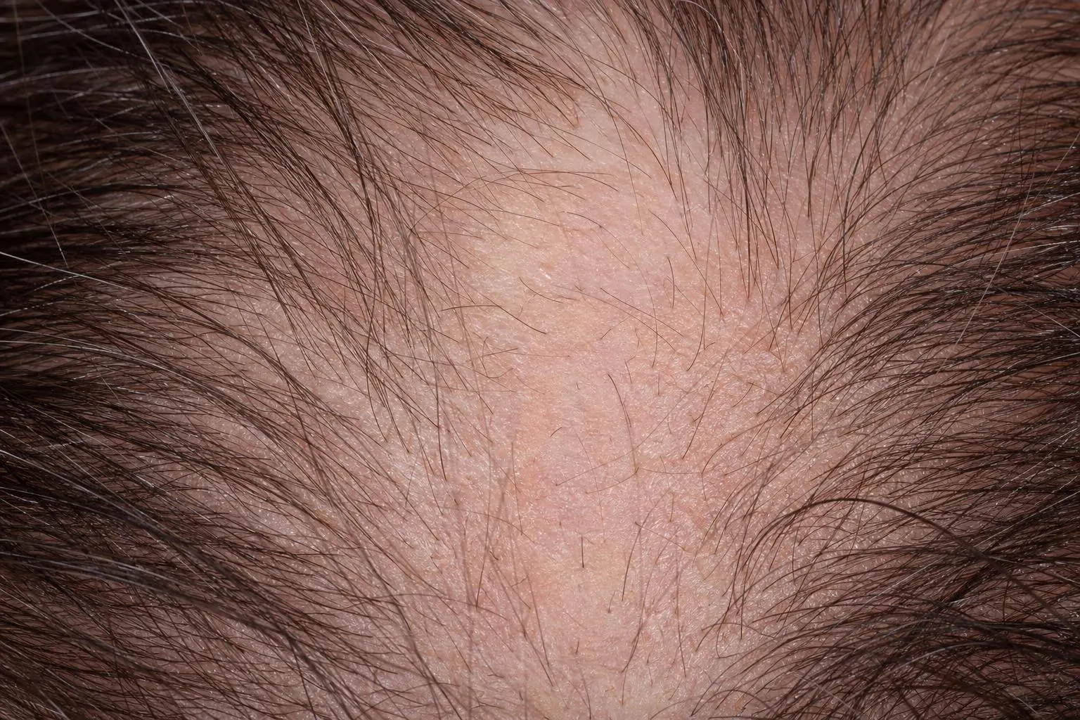 Alopecie