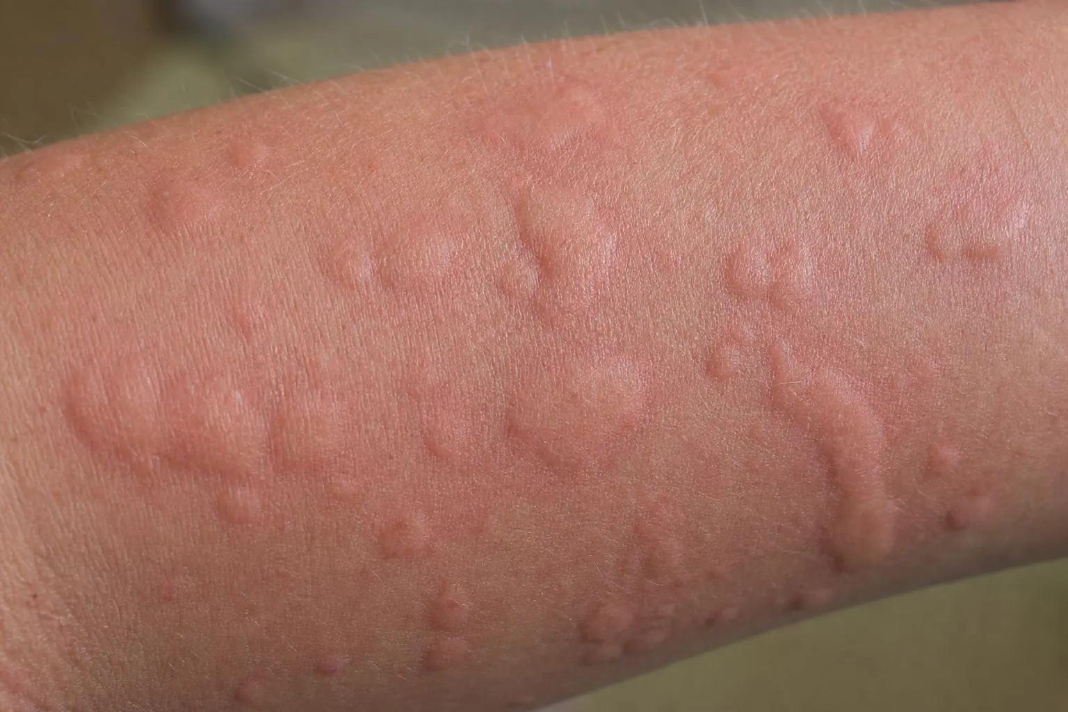 Urticaria