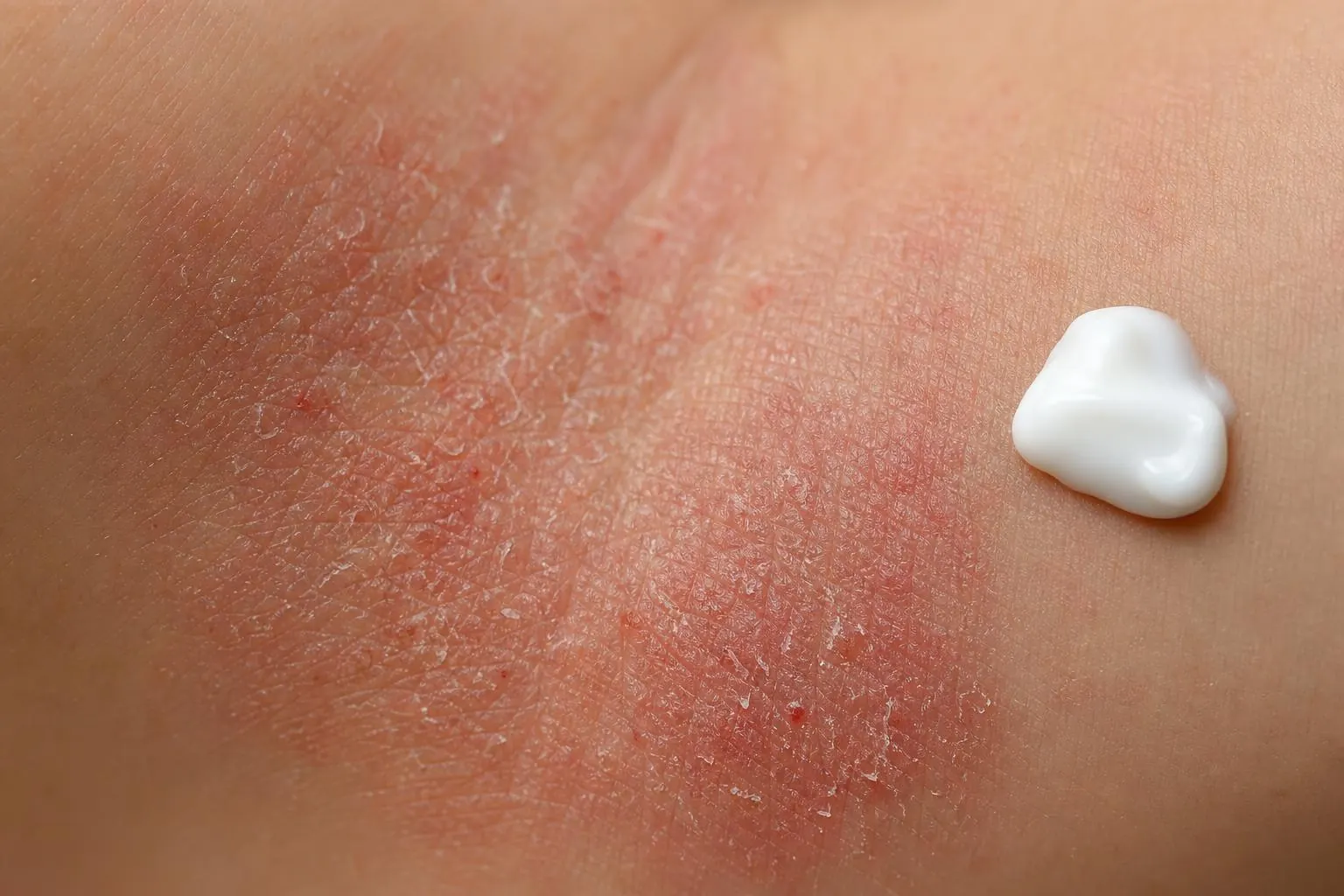 Dermatită atopică