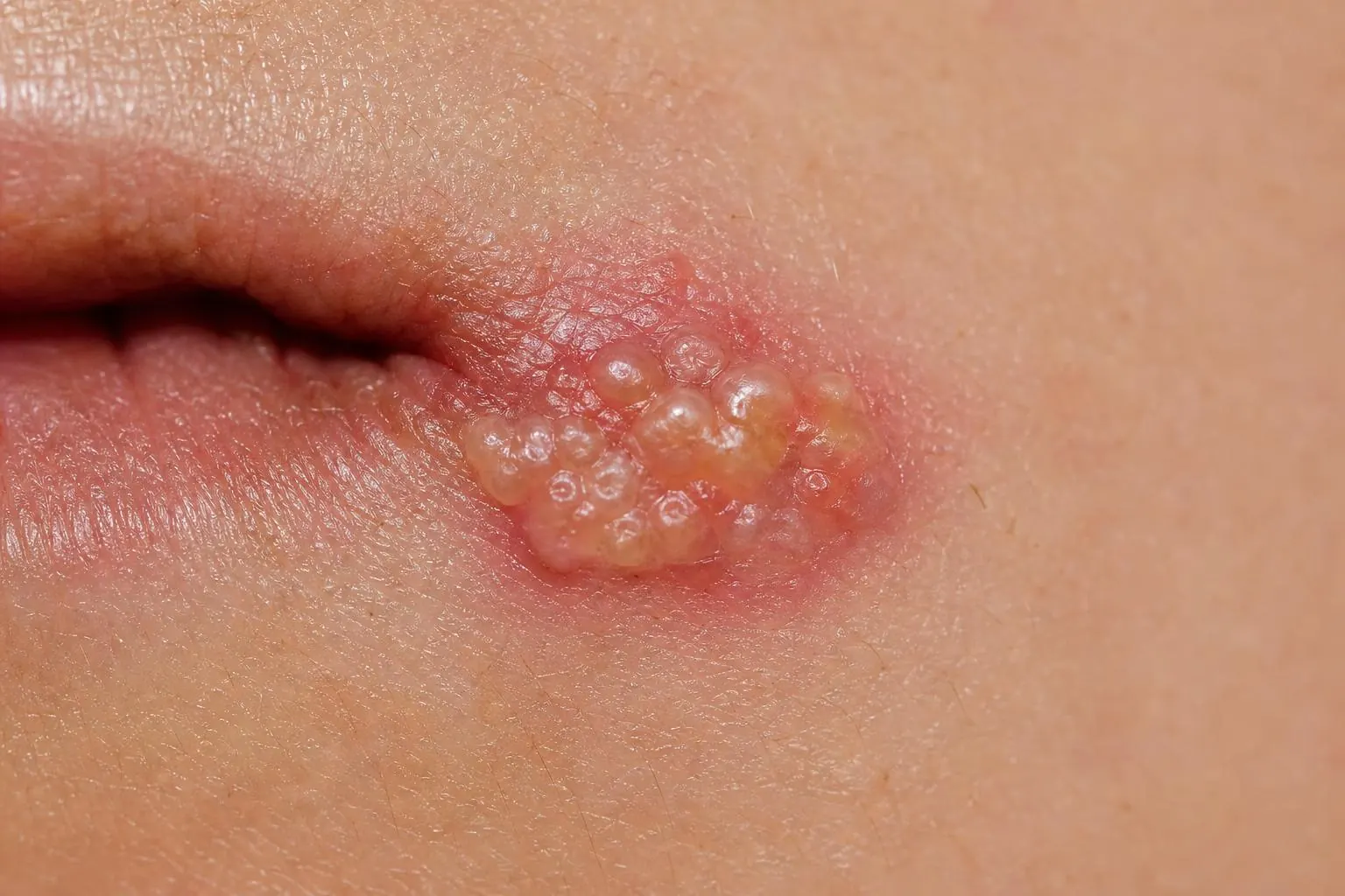 Herpes